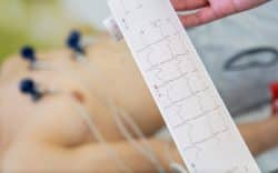 Elettrocardiogramma (ECG) in primo piano con paziente collegato agli elettrodi sullo sfondo