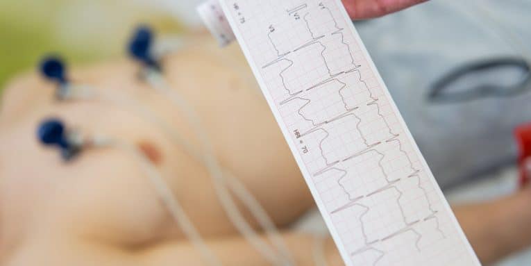 Elettrocardiogramma (ECG) in primo piano con paziente collegato agli elettrodi sullo sfondo