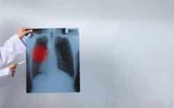 Radiografia del torace tenuta da una persona con area evidenziata in rosso