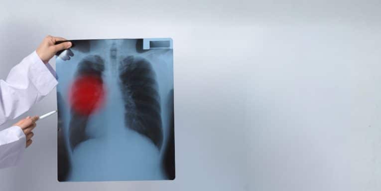 Radiografia del torace tenuta da una persona con area evidenziata in rosso