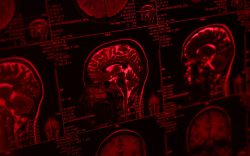 Sezioni di risonanza magnetica del cervello umano visualizzate su schermo