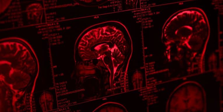 Sezioni di risonanza magnetica del cervello umano visualizzate su schermo