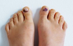 piedi con unghie degli alluci nere