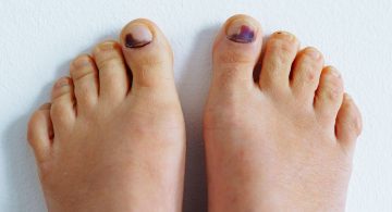 piedi con unghie degli alluci nere