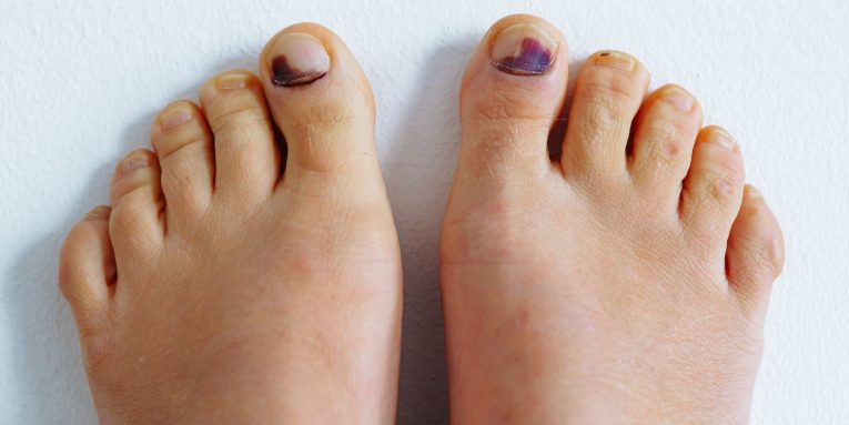 piedi con unghie degli alluci nere
