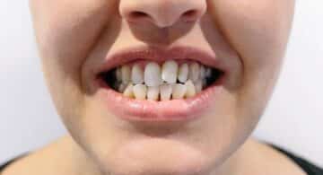 Malocclusione dentale - Sportiva Mens