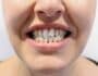 Malocclusione dentale - Sportiva Mens