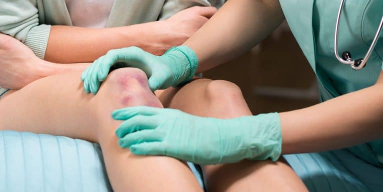 Contusioni al ginocchio - SportivaMens