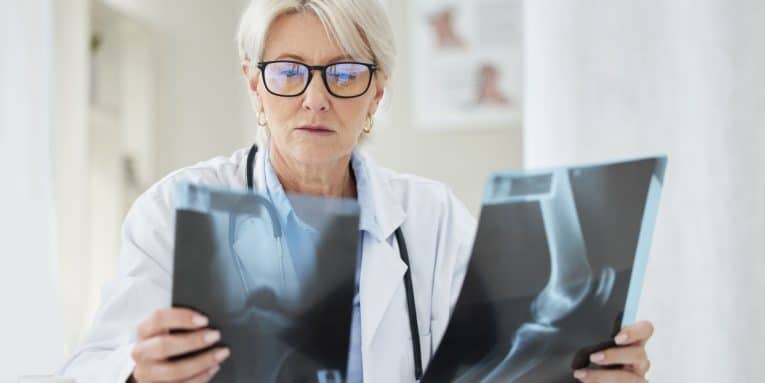 Osteofitosi - SportivaMens